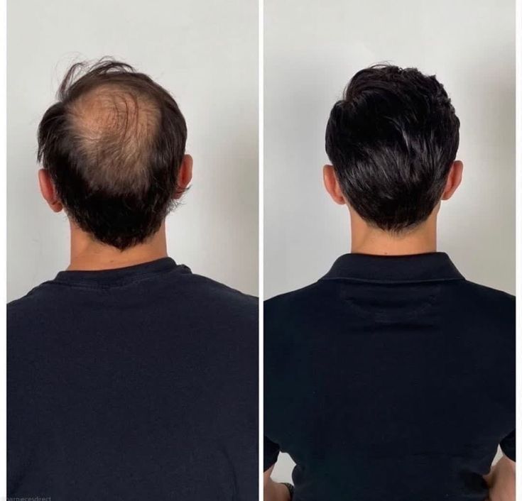 Comparação ilustrativa da região da coroa antes e depois